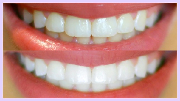 Teeth Care How I Whiten My Teeth +