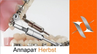 Herbst appliance. Аппарат Гербста. Ортодонтия.