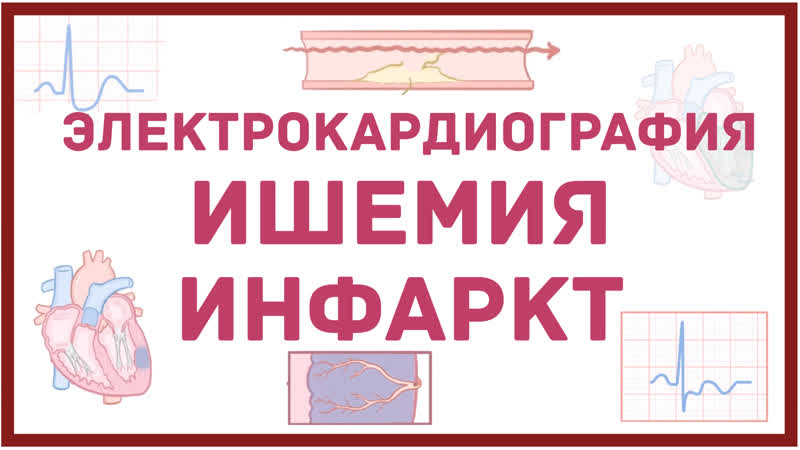 ЭКГ инфаркт и
